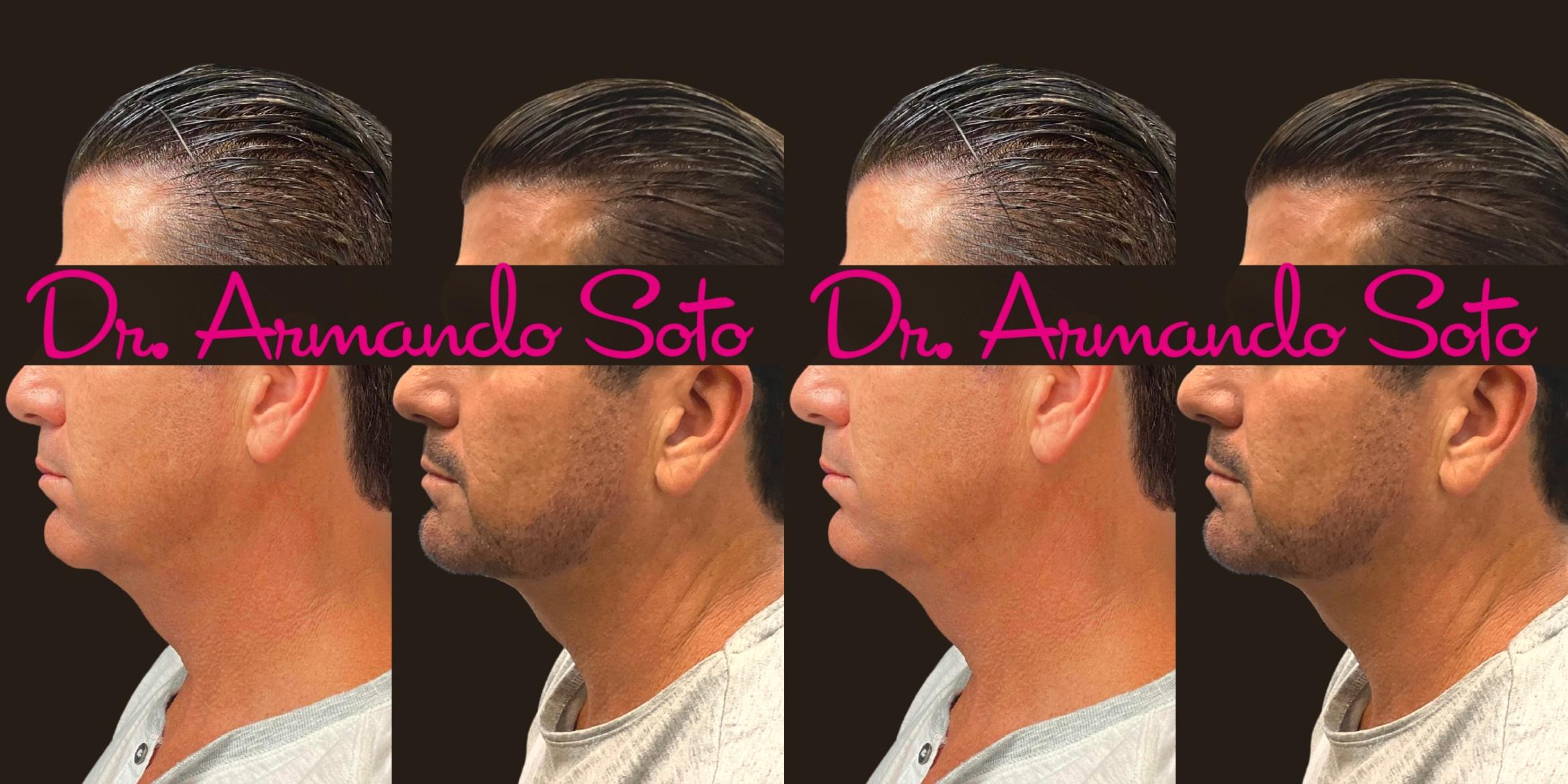 Before & After Ultherapy Case 76285 Left Side View in Orlando, FL