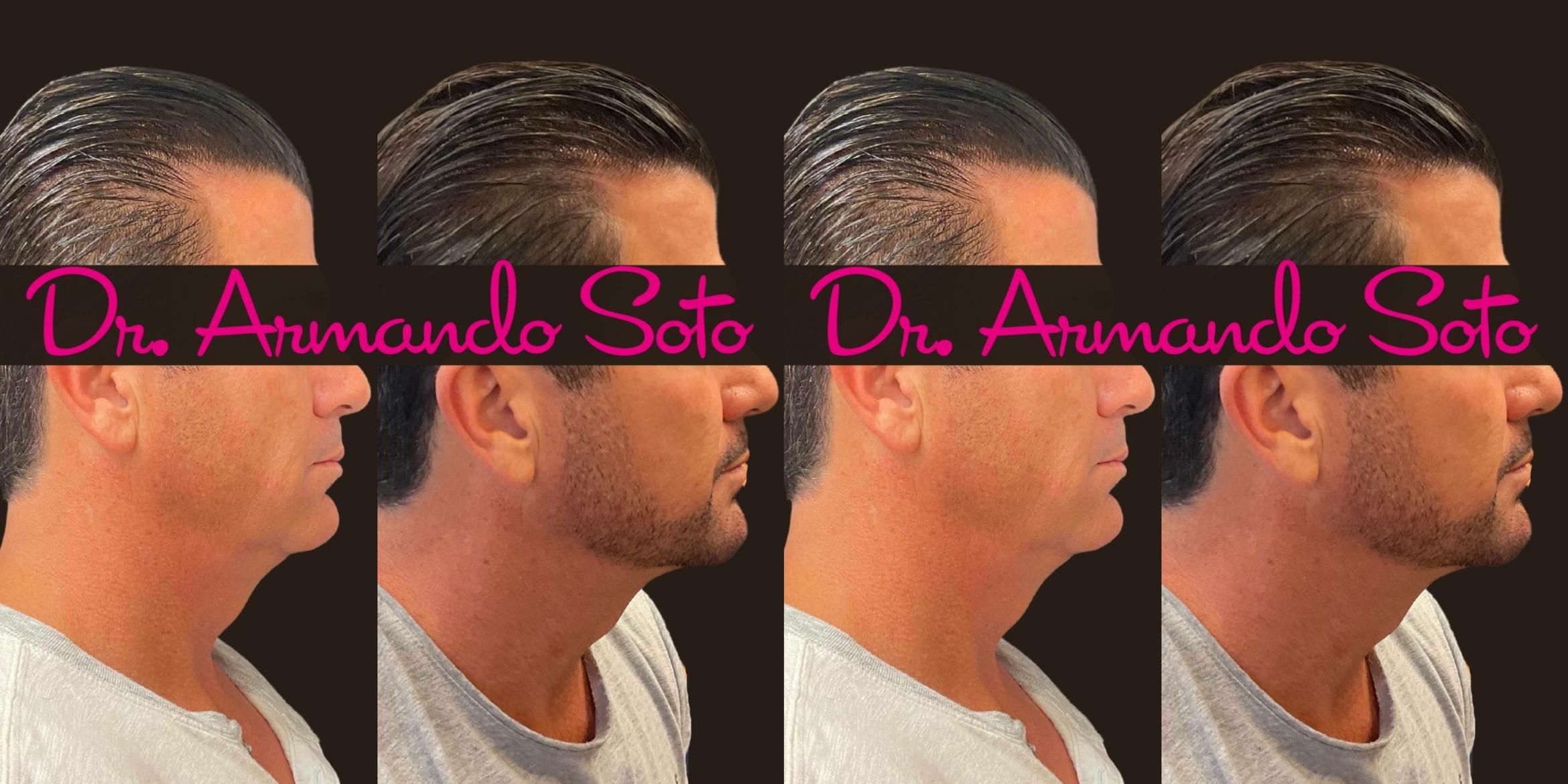 Before & After Ultherapy Case 76285 Right Side View in Orlando, FL