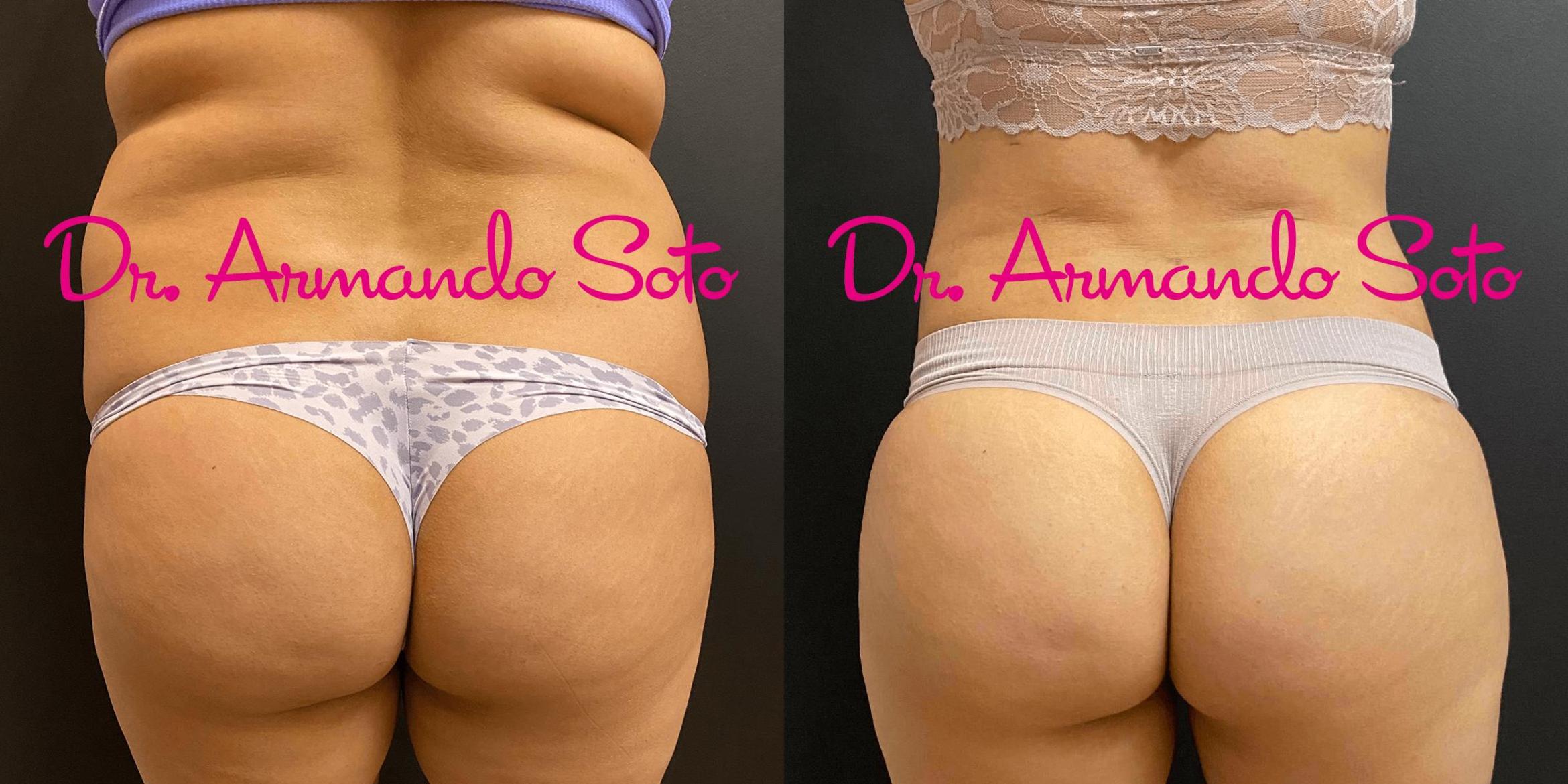 Before & After Vaser Liposuction Case 71924 View #1 View in Orlando, FL