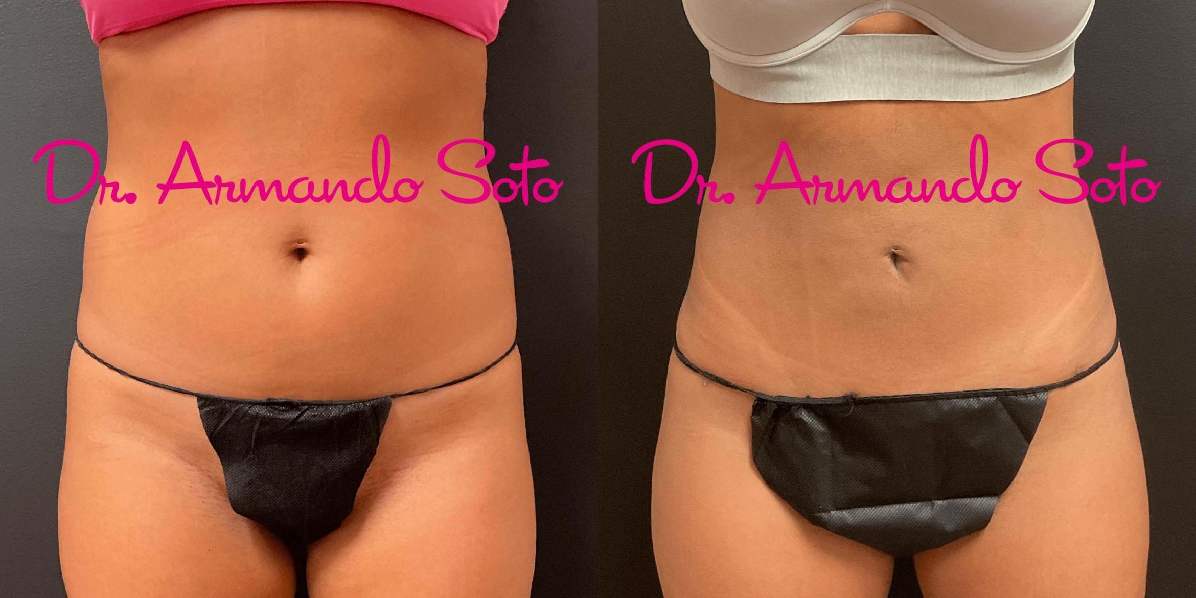 Before & After Vaser Liposuction Case 72368 View #1 View in Orlando, FL