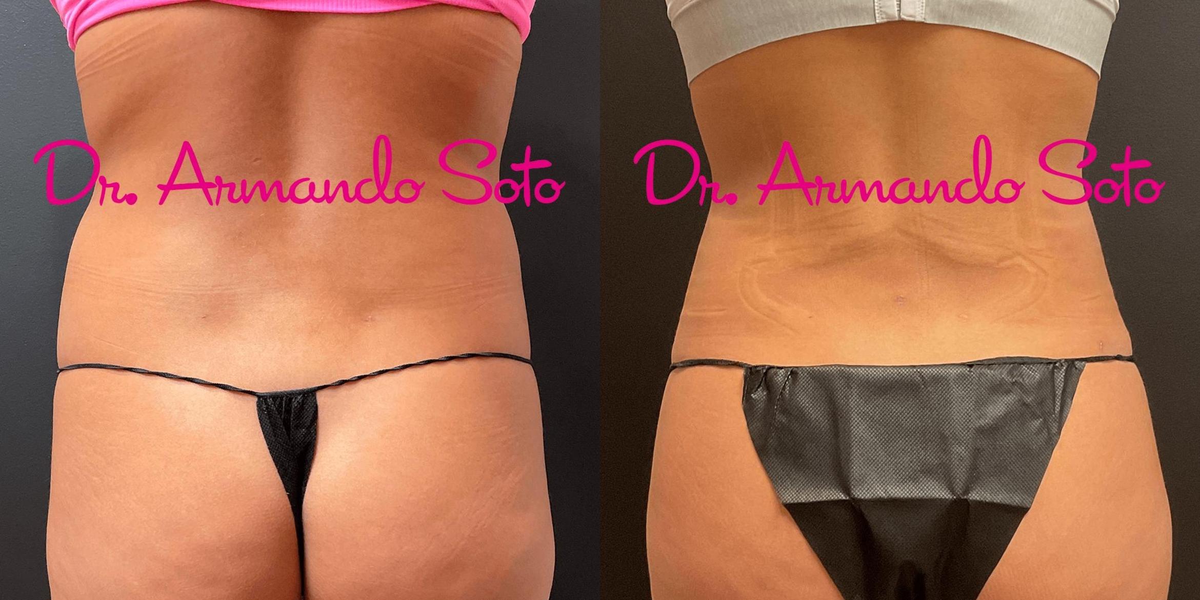 Before & After Vaser Liposuction Case 72368 View #2 View in Orlando, FL