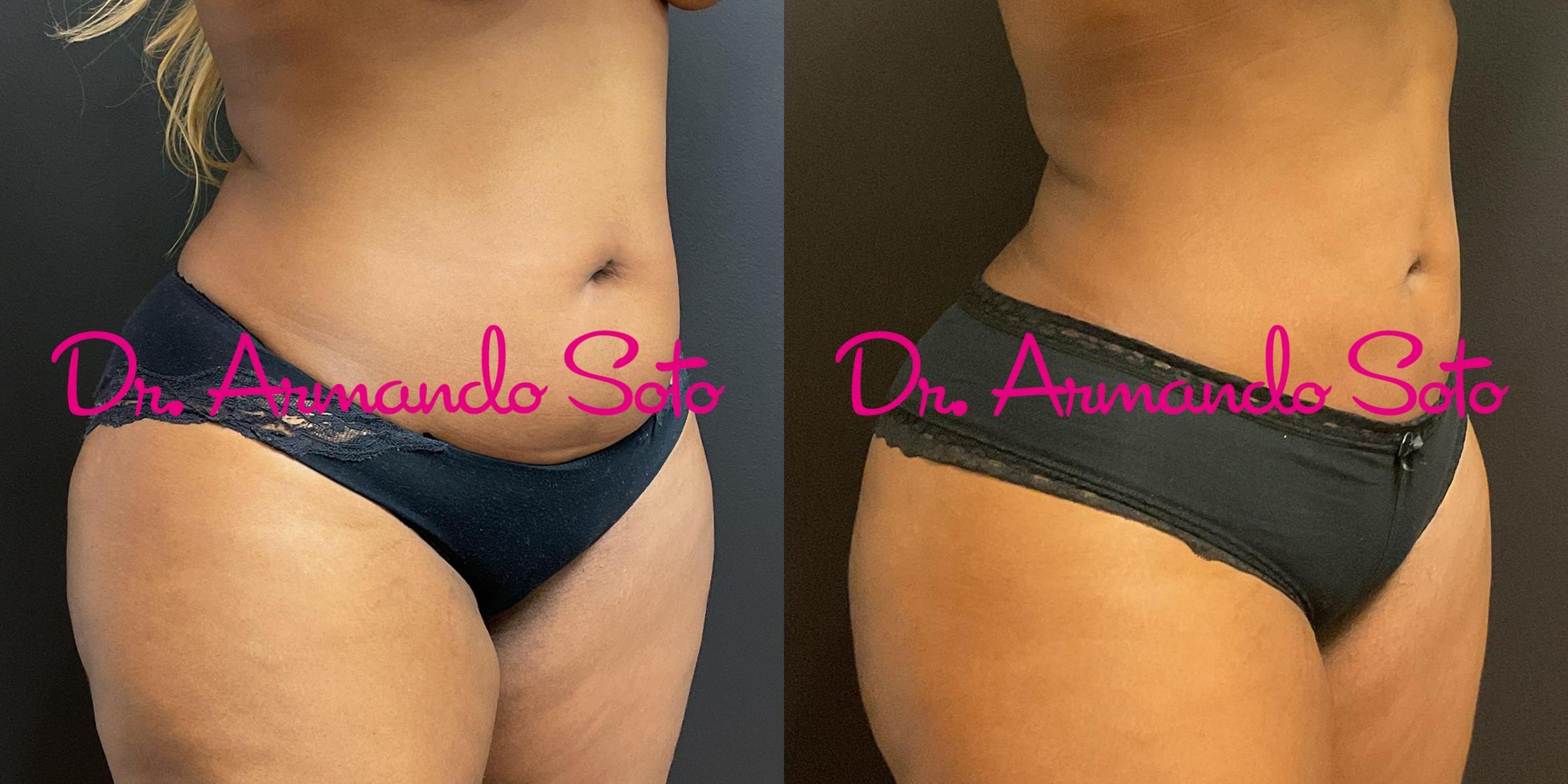 Before & After Vaser Liposuction Case 76280 Right Oblique View in Orlando, FL